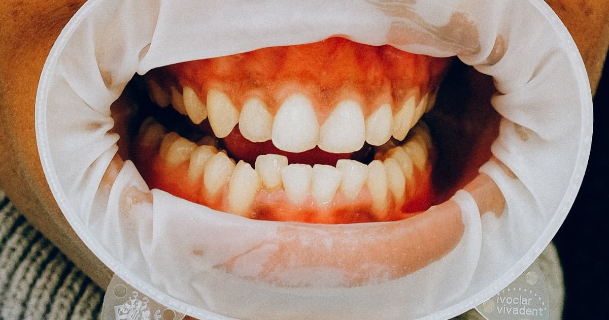 periodontitis y covid